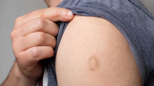 Monkey Pox Alert: दिल्ली मे मिला मंकीपॉक्स का पहला मामला
